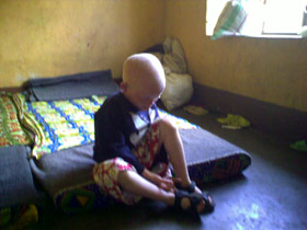 enfant-albinos-burundi-ruyg enfant-albinos-burundi-ruyg