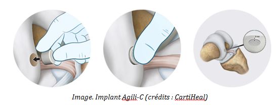 Image. Implant Agili-C (crédits : CartiHeal)